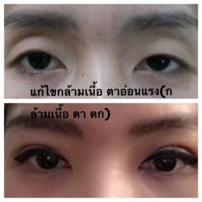 แก้ไขกล้ามเนื้อตาอ่อนแรง - คลินิกศัลยกรรมตกแต่งเสริมสวย รังสิต