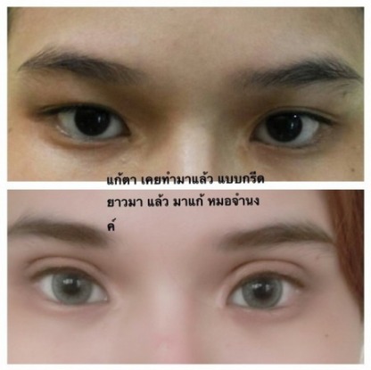 ทำตาสองชั้น - คลินิกศัลยกรรมตกแต่งเสริมสวย รังสิต