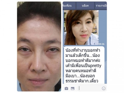 แก้ไขกล้ามเนื้อตาตก-ตาหย่อน - คลินิกศัลยกรรมตกแต่งเสริมสวย รังสิต