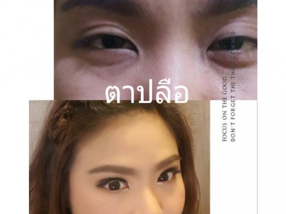 แก้ไขตาปรือ-ยกกระชับตา - คลินิกศัลยกรรมตกแต่งเสริมสวย รังสิต