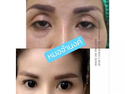 แศัลกรรมแก้ตาปรือ - คลินิกศัลยกรรมตกแต่งเสริมสวย รังสิต