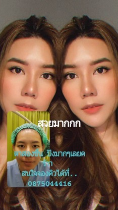 ทำตาสองชั้นหมอจำนงค์ - คลินิกศัลยกรรมตกแต่งเสริมสวย รังสิต