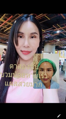 หมอจำนงค์ทำตา2ชั้น ราคาพิเศษ - คลินิกศัลยกรรมตกแต่งเสริมสวย รังสิต