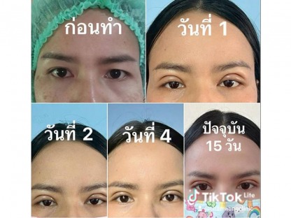 รีวิวทำตาสองชั้น - คลินิกศัลยกรรมตกแต่งเสริมสวย รังสิต