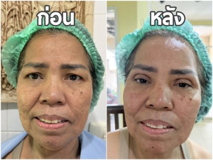 แนะนำคลินิกศัลยกรรมแก้ไขตา - คลินิกศัลยกรรมตกแต่งเสริมสวย รังสิต