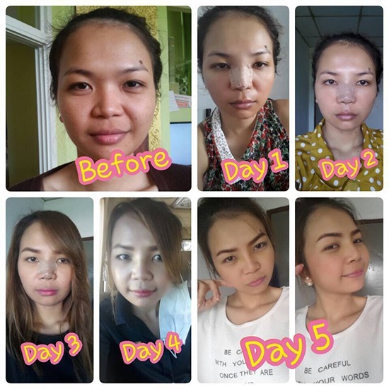 คลินิกศัลยกรรมตกแต่งเสริมสวย รังสิต - ทําจมูกเกาหลี หมอคนไหนดี