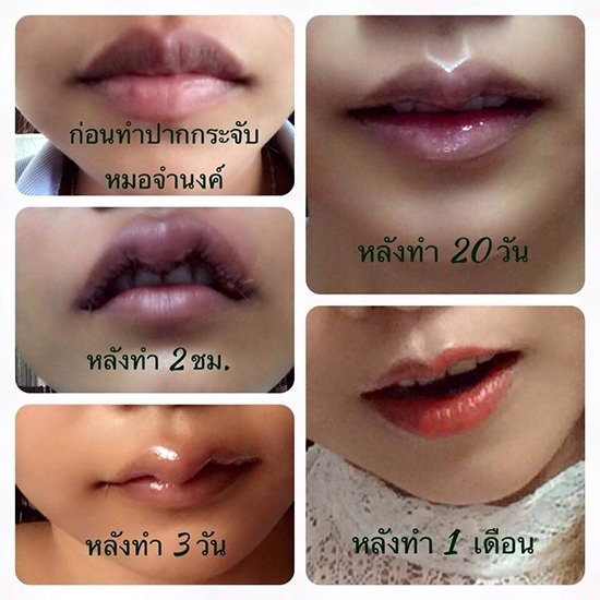 คลินิกศัลยกรรมตกแต่งเสริมสวย รังสิต - ศัลกรรมทำปากกระจับ