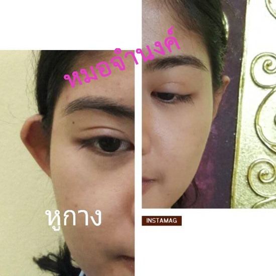 คลินิกศัลยกรรมตกแต่งเสริมสวย รังสิต - ศัลกรรมแก้ไขหูหาง