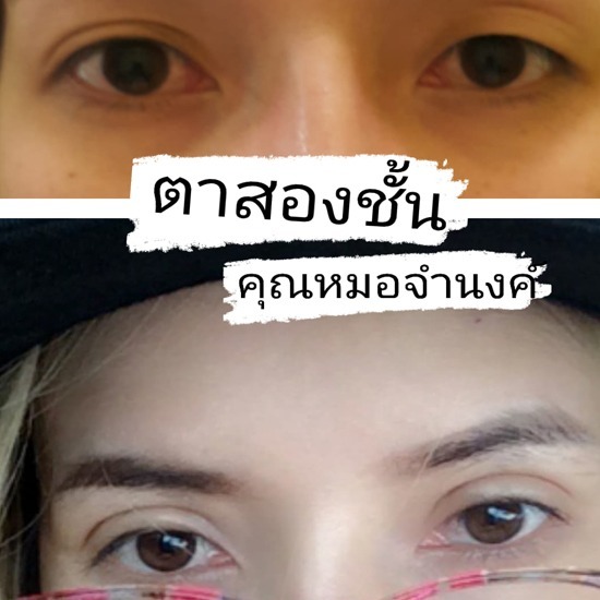 คลินิกศัลยกรรมตกแต่งเสริมสวย รังสิต - รับแก้ตาสองชั้นไม่เท่ากัน โดยหมอศัลยกรรม