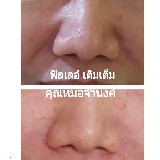 คลินิกศัลยกรรมตกแต่งเสริมสวย รังสิต - ฉีดฟิลเลอร์โดยแพทย์ศัลยกรรม ราคาพิเศษ