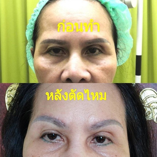 ยกคิ้ว ดึงคิ้ว แก้ไขหนังตาตก หมอจำนงค์ ยกคิ้ว ดึงคิ้ว แก้ไขหนังตาตก หมอจำนงค์