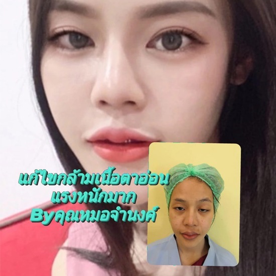 คลินิกศัลยกรรมตกแต่งเสริมสวย รังสิต - รับแก้ไขตาตก ตาปรือโดยเทคนิคหมอจำนงค์ รังสิต