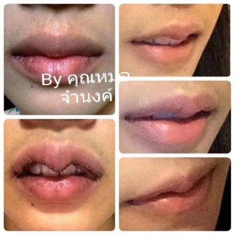 ศัลยกรรมทำปากบาง รังสิต