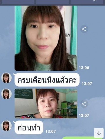 ปรับแก้โครงหน้าเบี้ยว