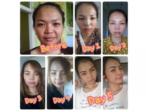 ทำจมูกเกาหลี-เจ็บตัวน้อย