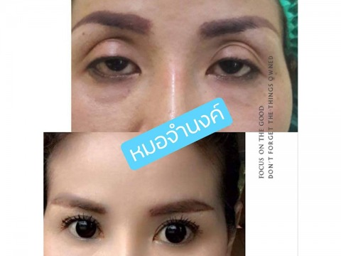 แศัลกรรมแก้ตาปรือ