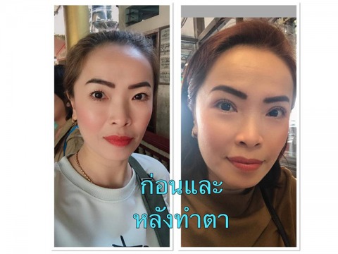 ทำตา-2-ชั้น-สำหรับคนอายุ-40