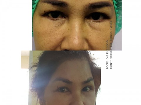 แนะนำคลินิกศัลยกรรมแก้ไขตา