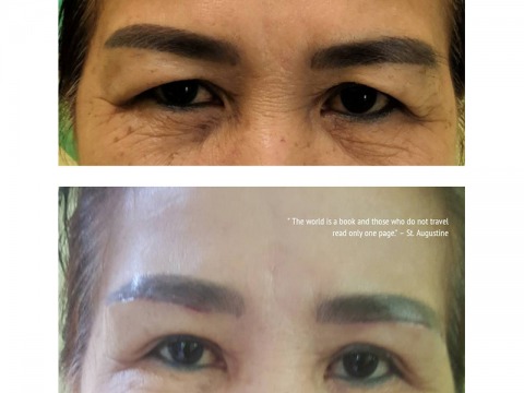 ศัลกรรมแก้หนังตาตก